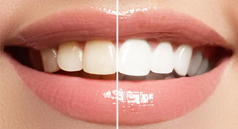 Advanced Smile Brightening at Dr. Pradeep Dental Clinic, Thiruvalla