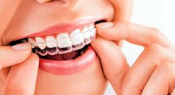 Clear aligner treatment