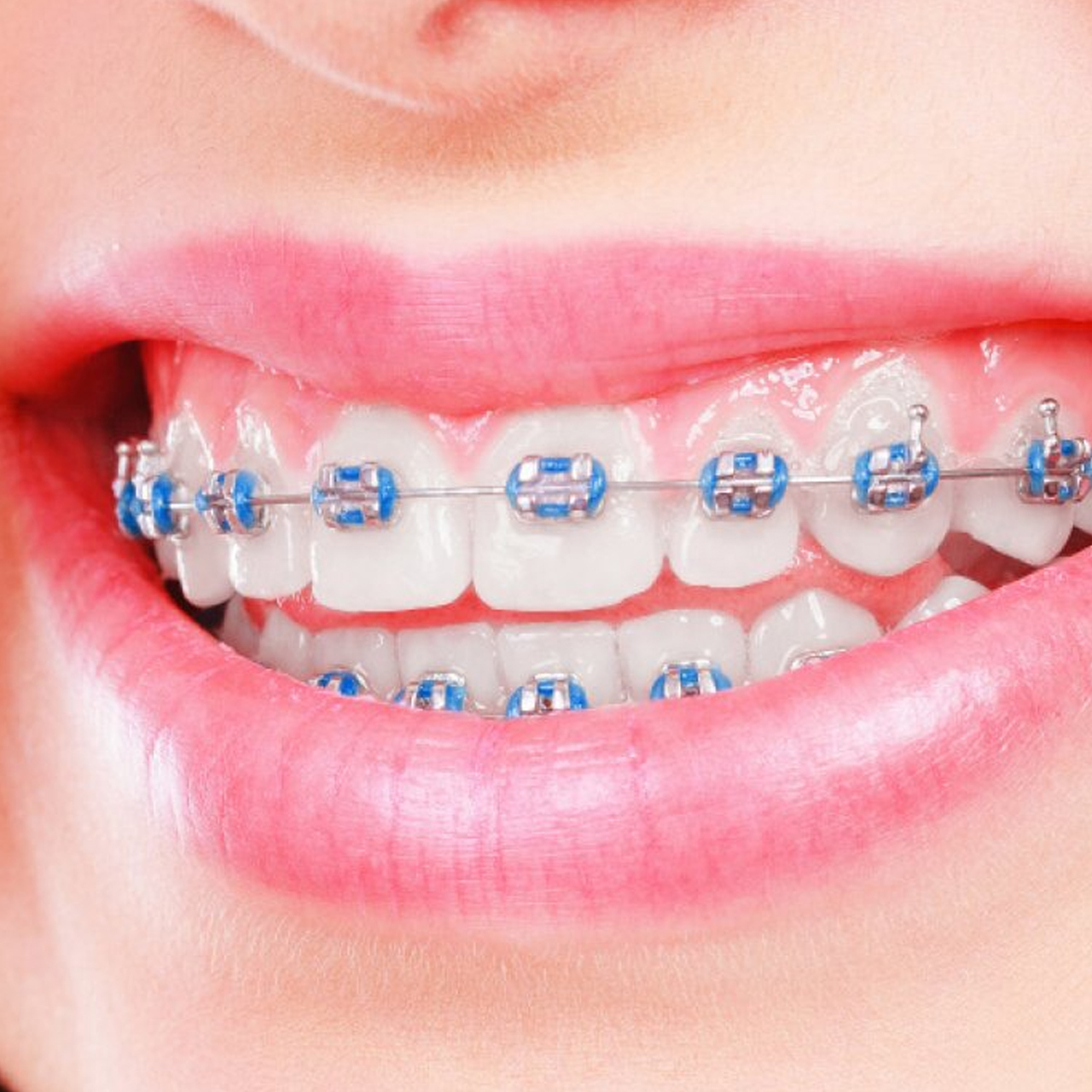 orthodontic treatment