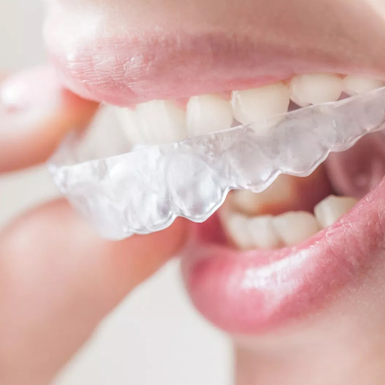  Clear Aligners